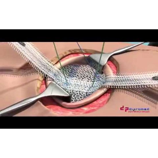 Umbilical clear mesh composite