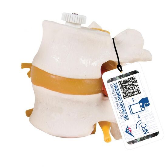 2 Human Lumbar Vertebrae with Prolapsed Disc, Flexibly Mounted – 3B Smart Anatomy