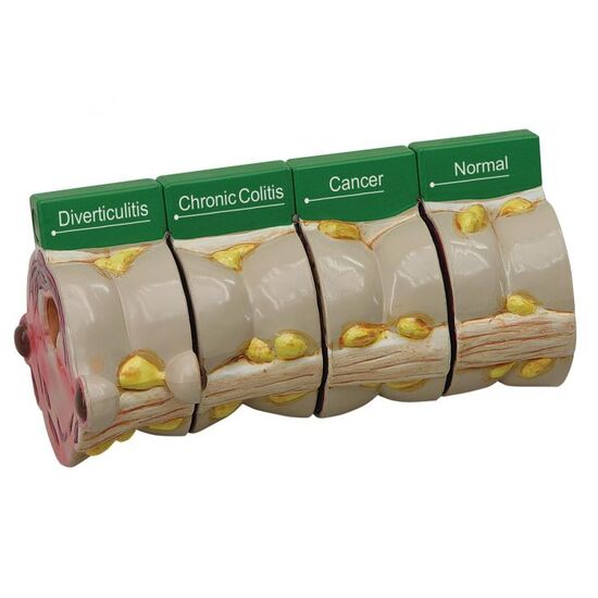 4 Piece Colon with Pathologies