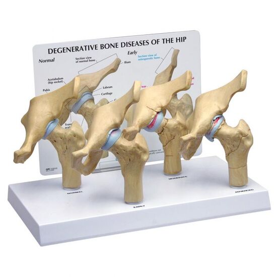 4-Stage Degenerative Bone Diseases of the Hip Model