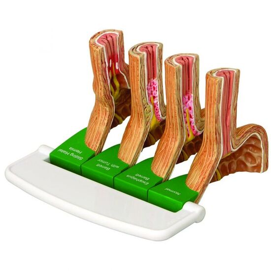 4-pc Gerd – (Gastro Esophageal Reflux Disease)