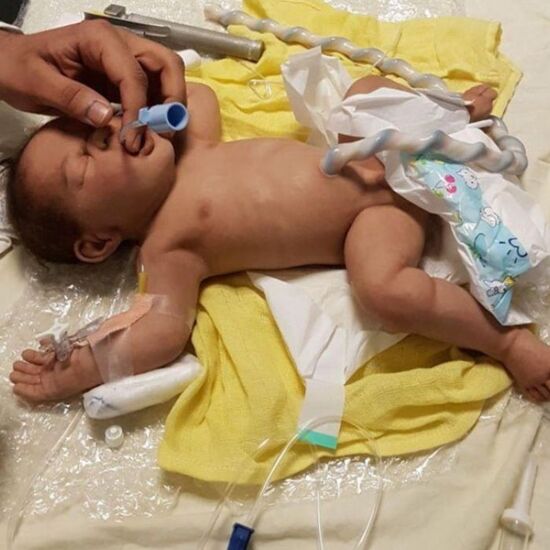 ALS Full Term Baby with Hip Examination