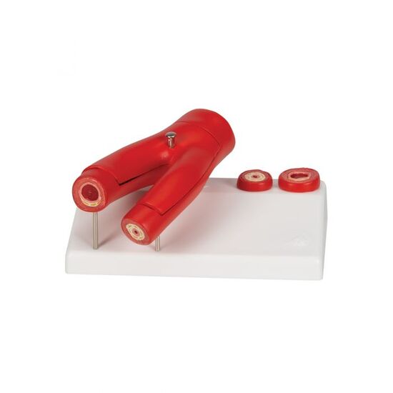 Arteriosclerosis Model, with Cross Section of Artery, 2 part – 3B Smart Anatomy