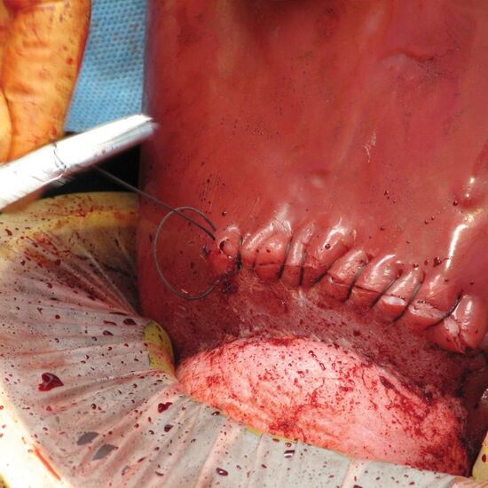 Emergency C-Section & Delivery Trainer – C-Celia