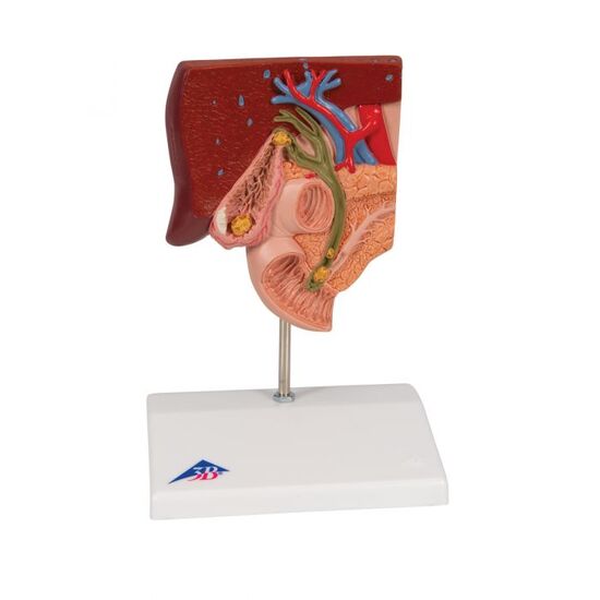Gallstone Model - 3B Smart Anatomy