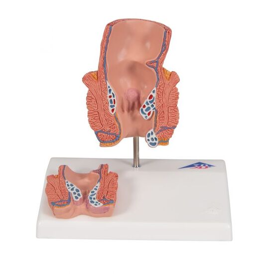 Hemorrhoid Model - 3B Smart Anatomy