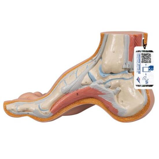 Hollow Foot (Pes Cavus) Model - 3B Smart Anatomy