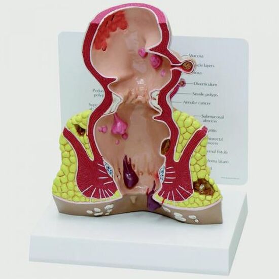 Rectum cross section (oversize) with pathologies