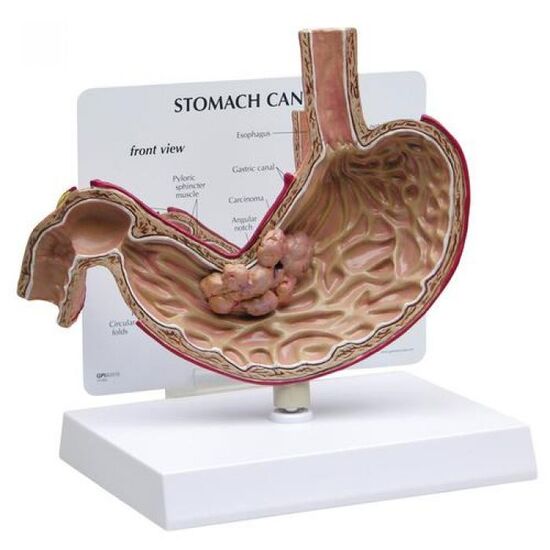 Stomach Cancer Model