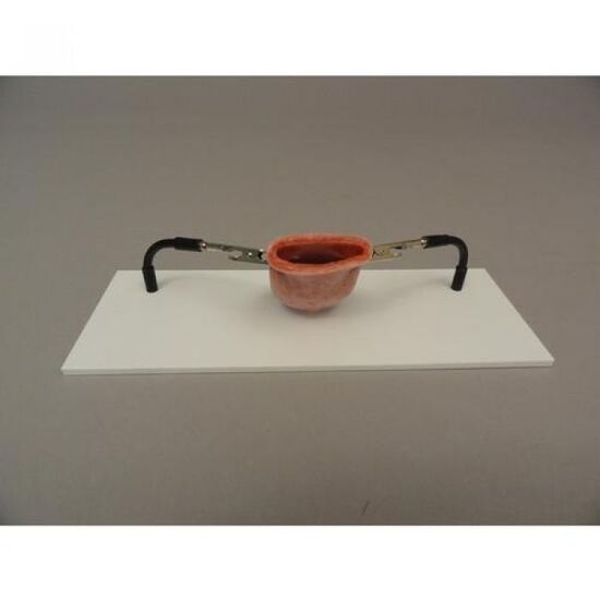 Vaginal cuff & ectopic pregnancy holder