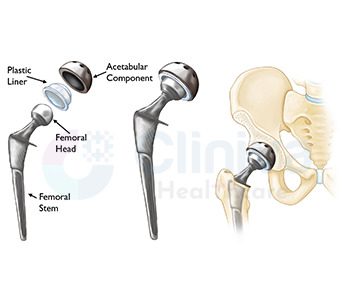 Hip Implants